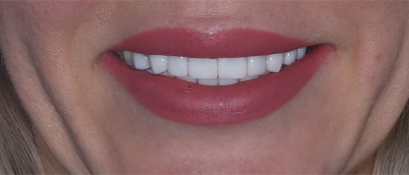 Виниры на передние зубы, 💰 стоимость керамических виниров на все зубы 18