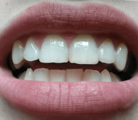 Отбеливание зубов Zoom 4 (Зум 4), цена в Москве в стоматологии "Профидент" 10