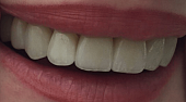 Виниры на передние зубы, 💰 стоимость керамических виниров на все зубы 30