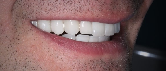 Виниры на передние зубы, 💰 стоимость керамических виниров на все зубы 19