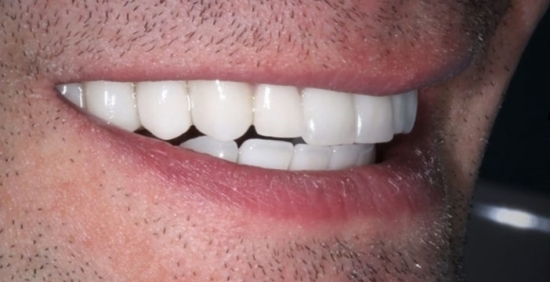 Способы восстановления зубов 🦷 безметалловой керамикой 2