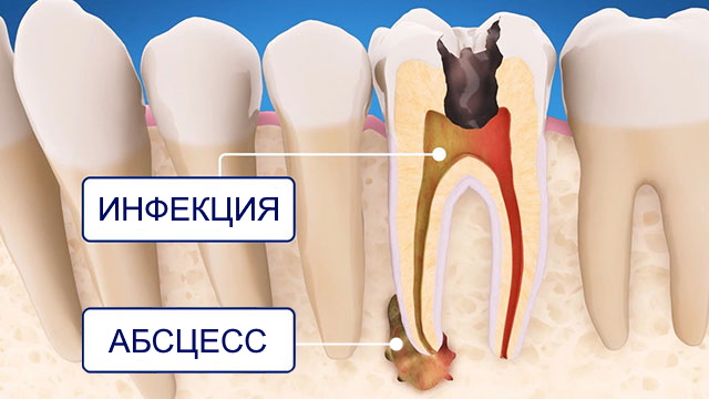 Что такое абсцедирующий зуб?