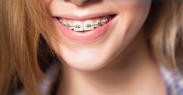 Гигиена зубов и полости рта во время ортодонтического лечения