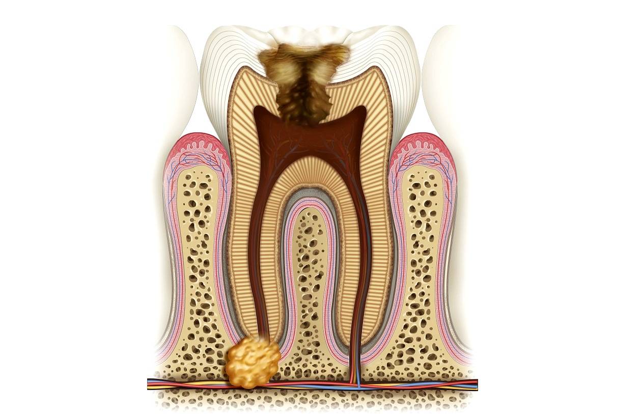 Гранулема зуба - причины, диагностика и лечение
 2