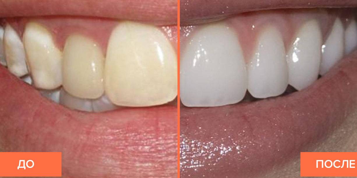 Белые пятна на зубах - причины, диагностика и лечение
 13