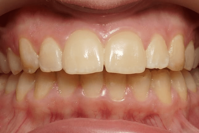 Виниры на передние зубы, 💰 стоимость керамических виниров на все зубы 26