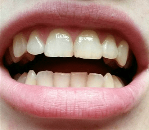 Отбеливание зубов Zoom 4 (Зум 4), цена в Москве в стоматологии "Профидент" 8