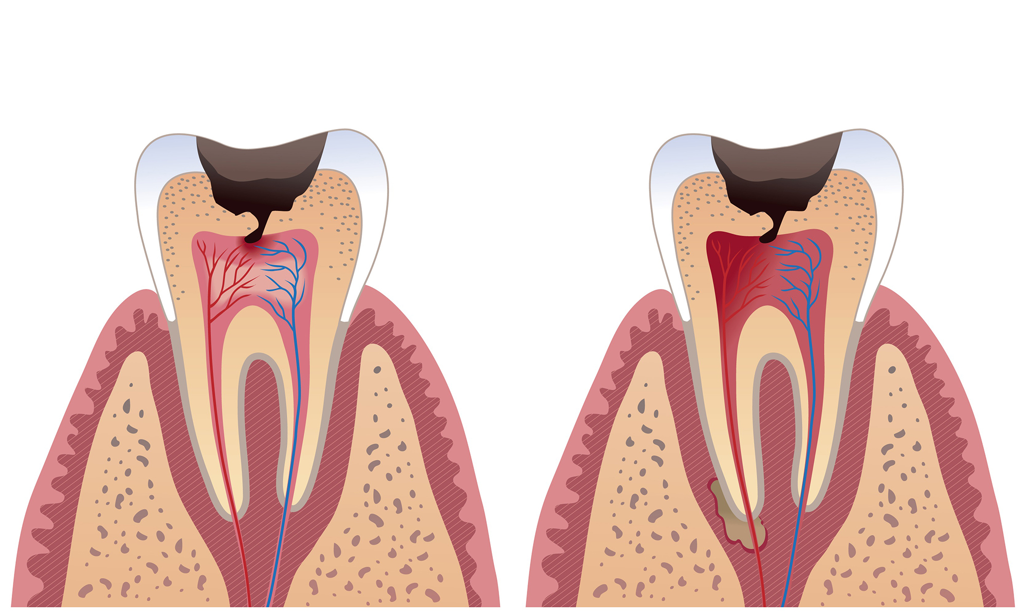 Гранулема зуба - причины, диагностика и лечение
 13