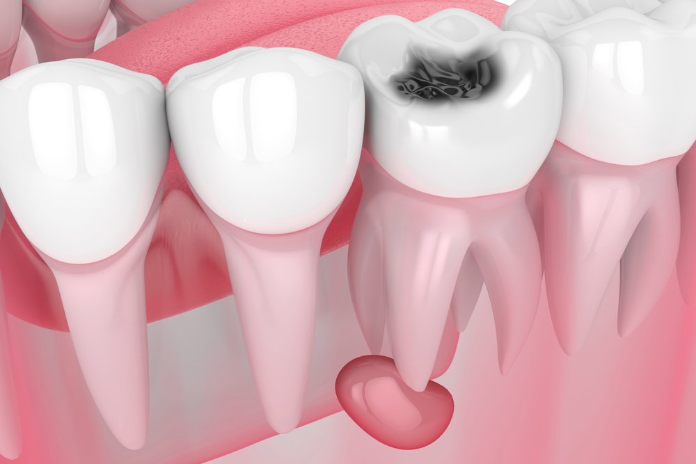 Киста зуба: как выглядит, как проявляется. 🦷 Киста корня зуба: как быть после кисты зуба 17