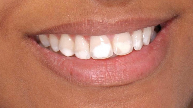 Белые пятна на зубах