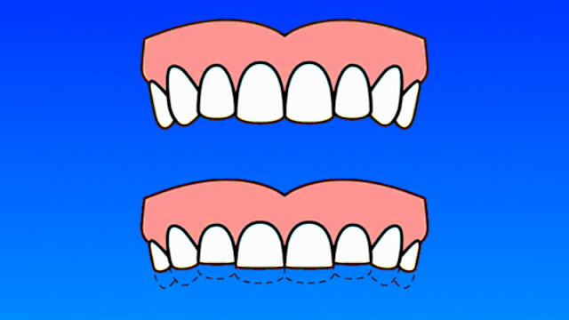 Бруксизм: почему скрипят зубами во сне
