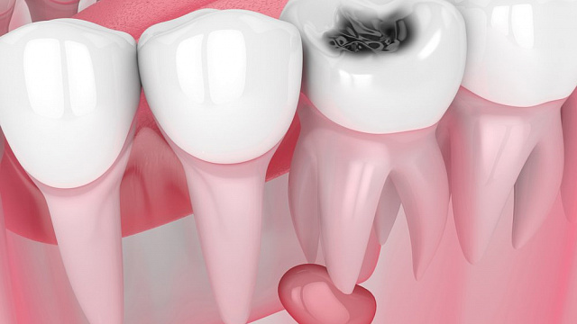Киста зуба: как выглядит, как проявляется
