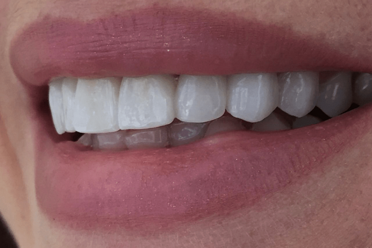 Виниры на передние зубы, 💰 стоимость керамических виниров на все зубы 20
