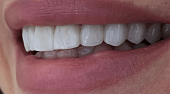 Виниры на передние зубы, 💰 стоимость керамических виниров на все зубы 28