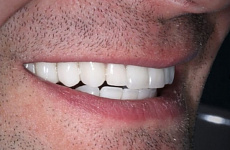 Виниры на передние зубы, 💰 стоимость керамических виниров на все зубы 39
