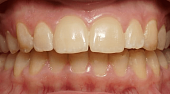 Виниры на передние зубы, 💰 стоимость керамических виниров на все зубы 31