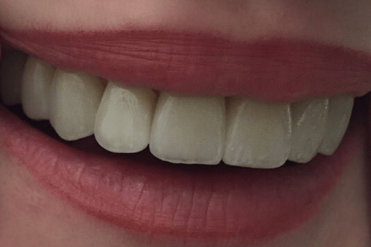 Виниры на передние зубы, 💰 стоимость керамических виниров на все зубы 24